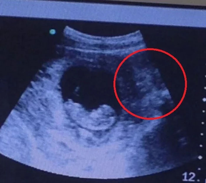 demnio observando criana no ultrassom